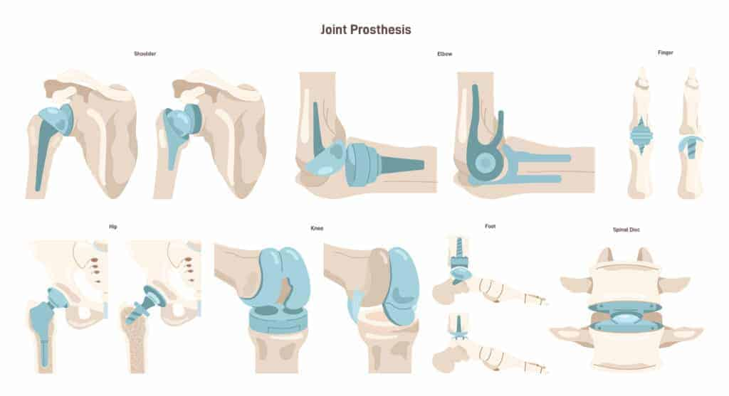 Joint prosthesis