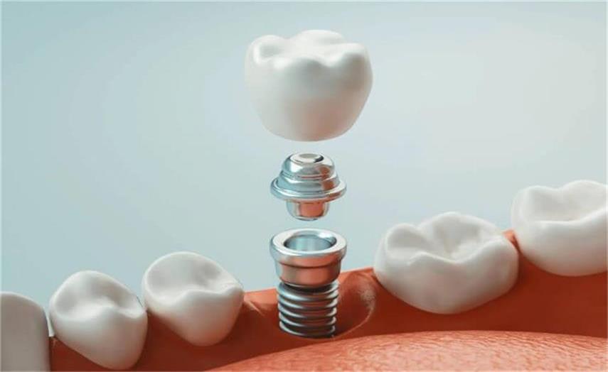 implantes dentales