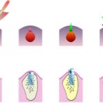 4 types of dental implants