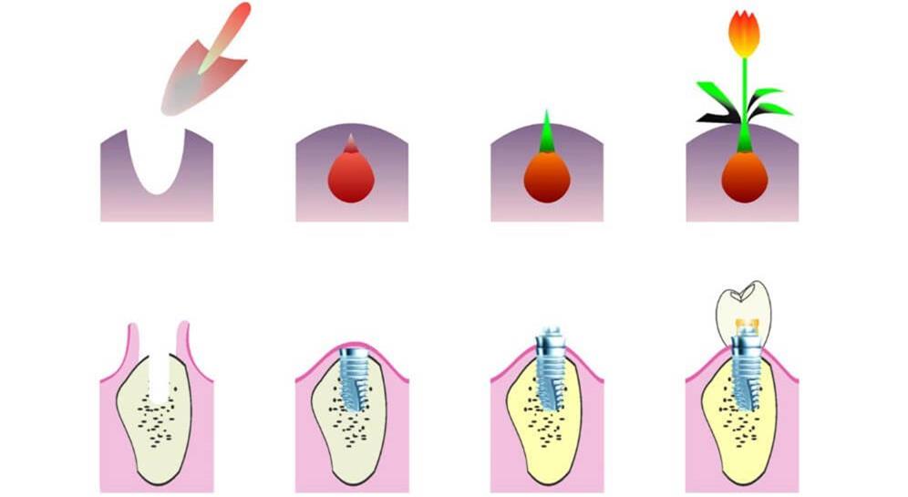 4 types of dental implants