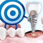 what are dental implants made of