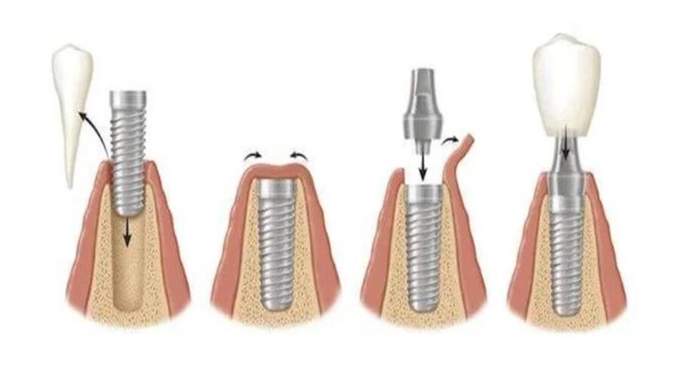 Titanium dental implant